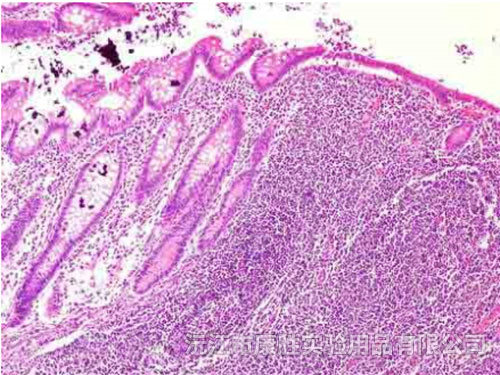 急性蜂窝织性阑尾炎