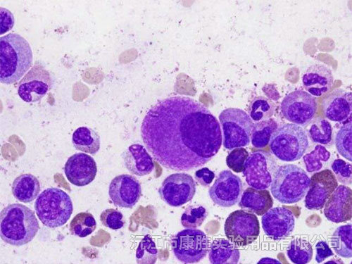慢性粒细胞白血病（CML)